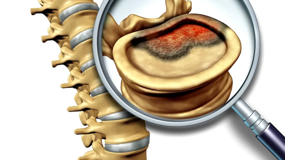 Tumorile măduvei spinării: simptome, tratament