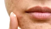VITAMINELE care îți lipsesc dacă apar mereu coșuri pe față