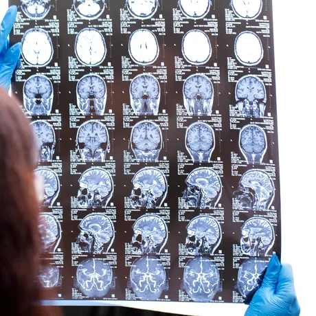 Primul copil vindecat de gliomul trunchiului cerebral, o formă extrem de agresivă de cancer. Povestea incredibilă a lui Lucas