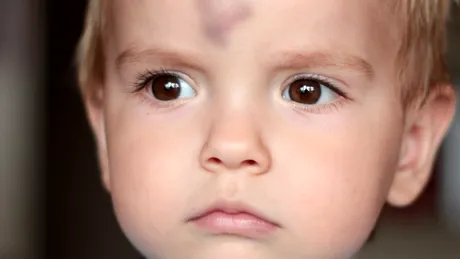 Trombastenia (boala Glanzmann): cauze, simptome, tratament