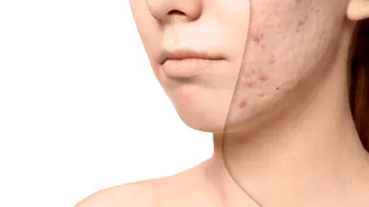 De ce apar petele pigmentare mai repede vara. Remedii naturale care uniformizează tenul