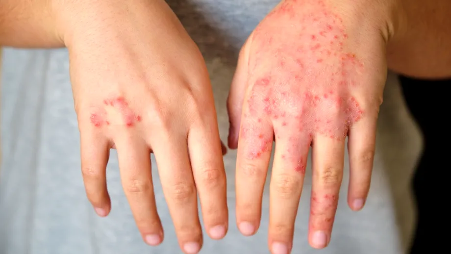 Semnul că tratamentul tău pentru psoriazis nu mai funcționează. Medicii spun când trebuie schimbat
