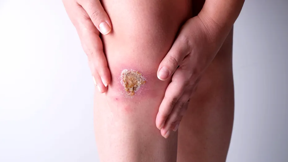 Răni care se vindecă greu - ce boli grave pot ascunde?