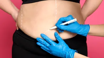 Prima vară după chirurgia bariatrică: cum îți schimbi corpul, dar și relația cu tine însuți