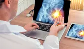 Pericolul neașteptat al corticosteroizilor folosiți în pandemie. Medic: Mulți pacienți sub 40 de ani au dezvoltat necroză de cap femural, care duce la coxartroză