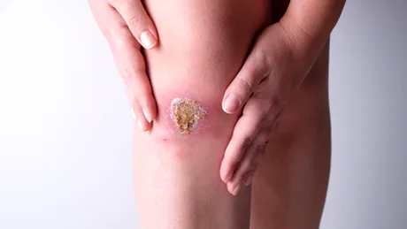 Răni care se vindecă greu - ce boli grave pot ascunde?