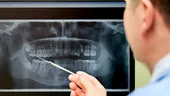 Peste 50% dintre românii cu vârste de peste 40 de ani au lucrări dentare cu plombe cu mercur, tehnică periculoasă, interzisă deja în UE de la începutul anului 2025