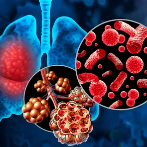 Cum deosebești o simplă răceală de pneumonie: semne care nu trebuie ignorate