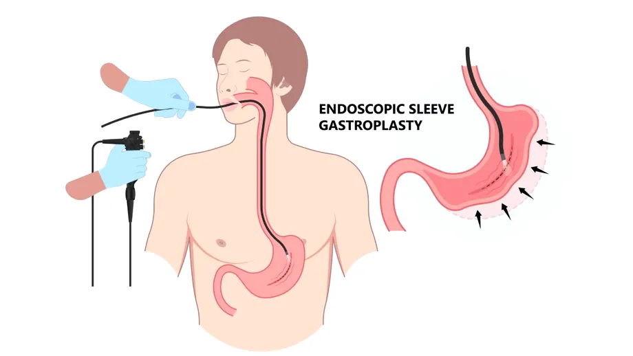 ESG (micșorarea de stomac pe cale endoscopică): alternativa endoscopică pentru slăbire, fără operații invazive