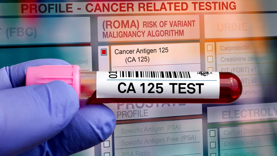 Testul sau scorul ROMA: ce este, când se recomandă, valori normale și limite