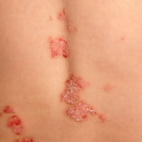Remedii naturale care pot ajuta în psoriazis. Ce metode au fost studiate și ce trebuie evitat?