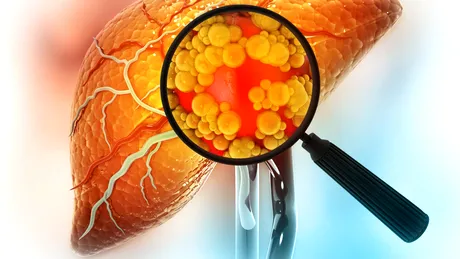 Boala ficatului gras non-alcoolic nu se tratează cu suplimente alimentare neverificate!