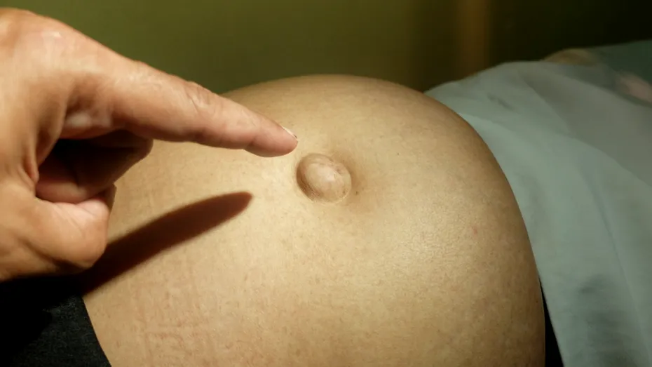 Semnul vizibil pe abdomen care poate trăda o hernie. La început poate să nu doară deloc