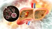 O dietă populară, vinovată pentru cancerul hepatic. Accelerează apariția lui prin „reprogramarea” celulelor hepatice