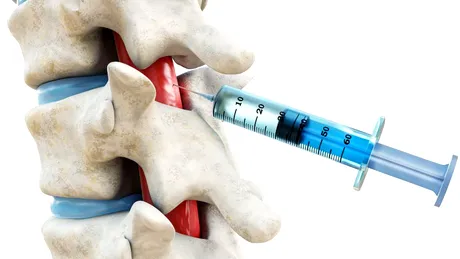 Injecțiile epidurale cu steroizi pentru durerile de spate. Când sunt indicate și ce efecte secundare pot avea?