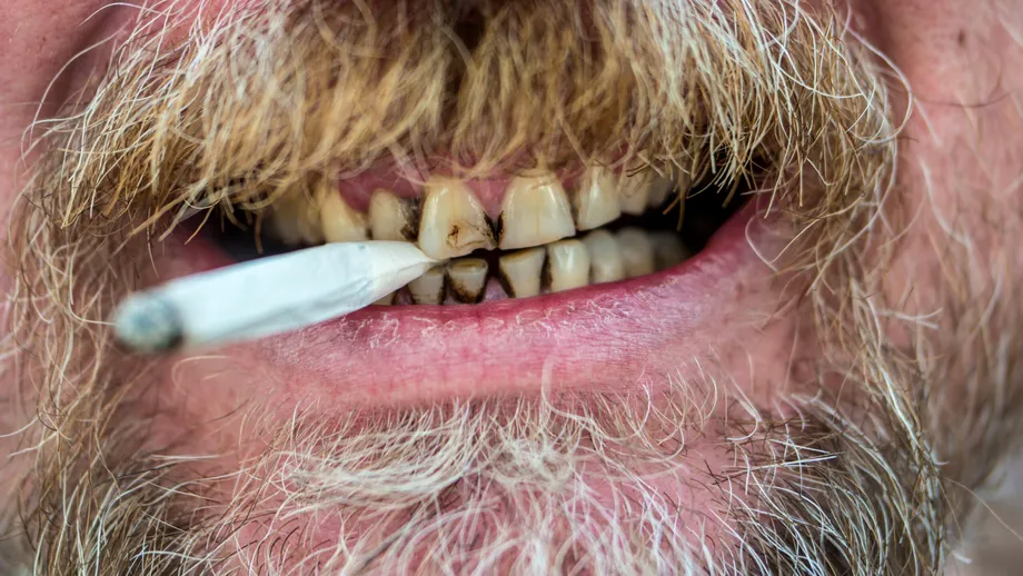 Singura soluție eficientă împotriva petelor negre de nicotină de pe dinți