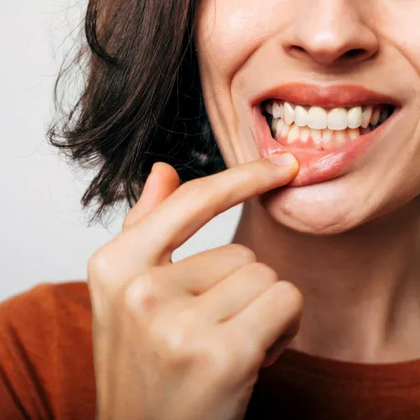 Trend pe TikTok: tinerii își zgârie dinții și gingiile ca să scape de tartru acasă. De ce este periculos!