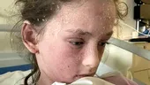 Boala rarisimă cu care a fost diagnosticată această adolescentă. E alergică la propriile lacrimi, dar nu doar atât