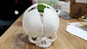 Caz spectaculos. O fetiță născută fără o parte din craniu a fost salvată cu ajutorul unei imprimante 3D