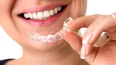 Îndepărtarea aparatului dentar - ce rol are gutiera de contenție