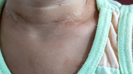 Lichen striat: cauze, simptome, tratament