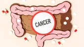 4 boli care cresc riscul de cancer de colon. Ce analize se fac preventiv
