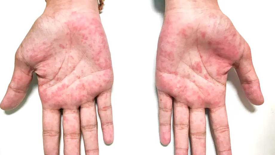 Eczema dishidrotică: ce este, simptome și tratament