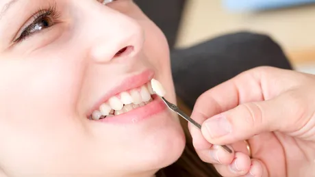 Aparat dentar sau fațete pentru corectarea dinților strâmbi? Avantaje și dezavantaje