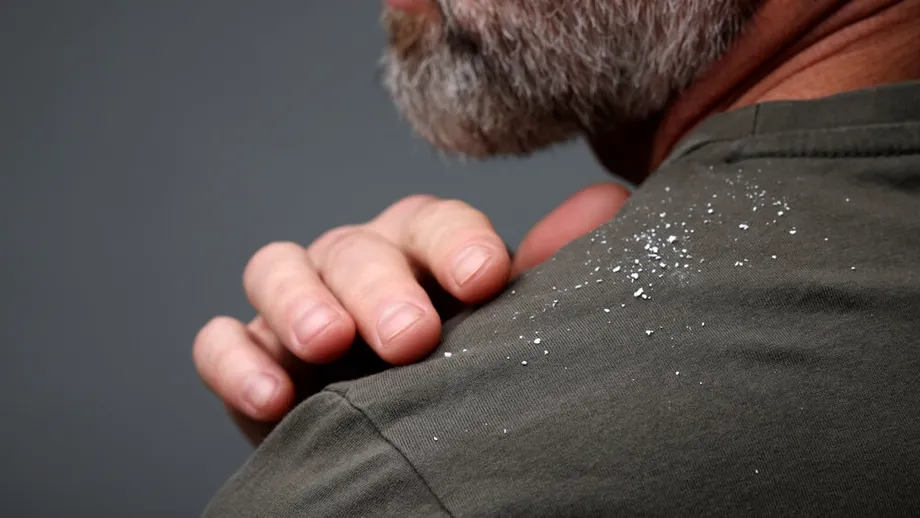(P) Mătreață și seleniu: beneficii pentru microbiomul scalpului