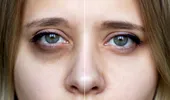 Ce înseamnă Ferritin Face, termenul devenit viral pe TikTok? Are legătură cu deficitul de fier!