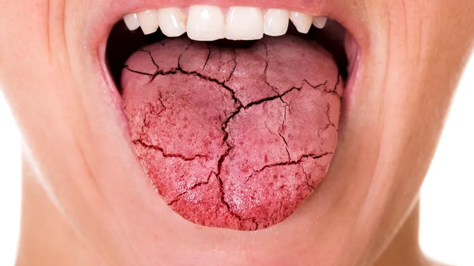 Uscarea gurii poate fi un simptom al stresului în exces