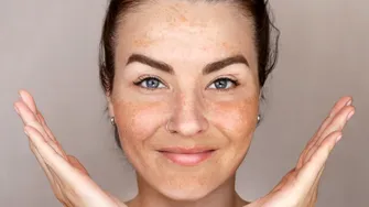 De ce poți avea pete pigmentare chiar dacă folosești cremă cu SPF