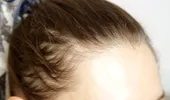 Slăbești, dar îți cade părul? Ce legătură au injecțiile pentru slăbit cu alopecia