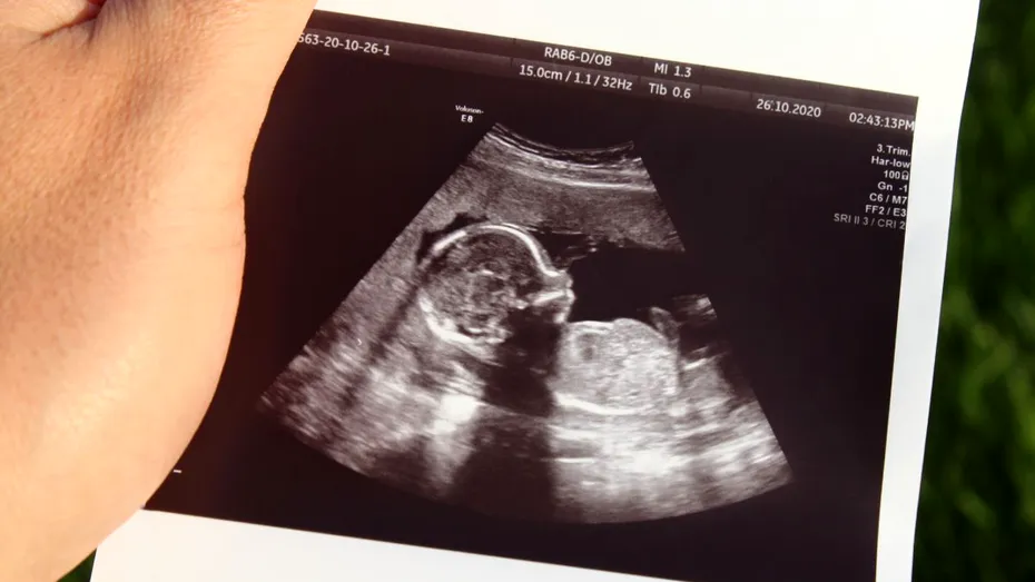 Legătura dintre diabetul în timpul sarcinii și riscul de autism sau ADHD al fătului