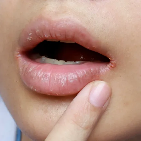 Buze uscate și crăpate? Remediul de casă care le salvează instant