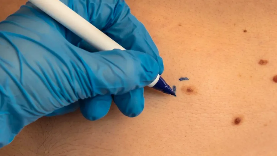 Sunt papiloamele periculoase? Ce sunt și cum le putem îndepărta în siguranță