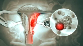 Peste 40% dintre femeile cu cancer ovarian află diagnosticul abia după o urgență medicală. Simptome pe care nu trebuie să le ignori, de la balonare persistentă, la urinări frecvente