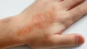 Dermatita se agravează la frig. 10 boli de piele care ne fac zile fripte iarna