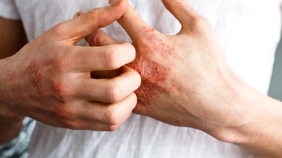 Eczema: cauze, simptome, tratament, prevenţie