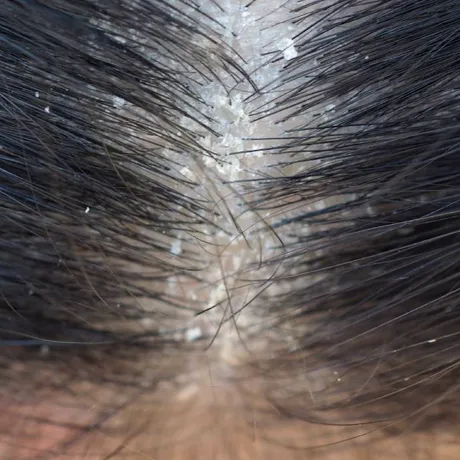 Ce ingrediente trebuie să conțină șamponul ca să scapi de mătreață. Trebuie neapărat să fie pe etichetă!