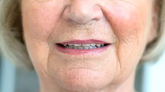 Subțierea buzelor și ridurile din jurul gurii, consecințele unei probleme dentare care afectează mulți români