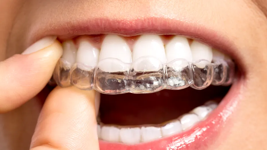 Aparatul dentar transparent versus aparat dentar clasic