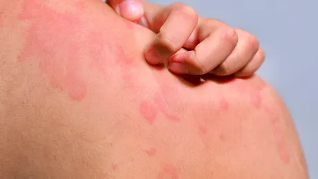 Urticaria cronică spontană: cât durează, de ce apare și când trebuie să mergi la medic