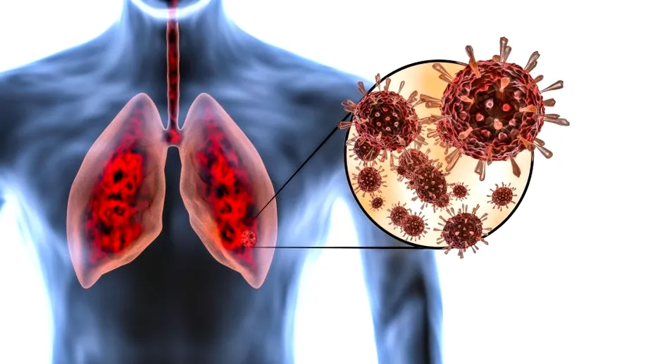 Mulți pacienți au sechele pulmonare după COVID, chiar și la 2 luni de la vindecare