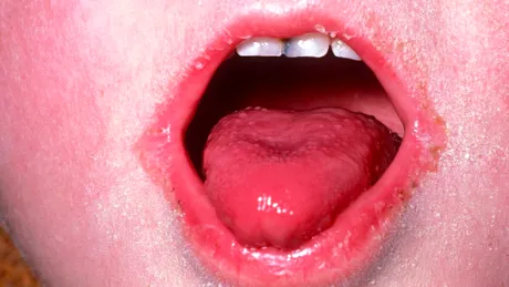 Limba zmeurie la copii, semnul unei boli contagioase care umple camerele de gardă. Dr. Mihai Craiu: „Panica nu ajută la nimic”