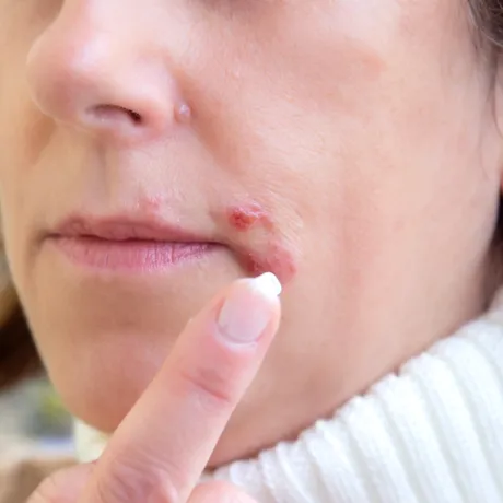 Remedii simple și eficiente împotriva herpesului. Ce funcționează cu adevărat și când trebuie să acționezi