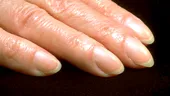 Semnul timpuriu de pe degete care ascunde cel mai temut cancer. Aproape 40% din bolnavi au acest simptom
