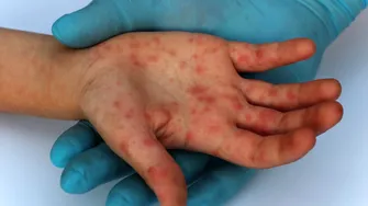 Ce este variola maimuței, noua infecție virală care pune pe jar o lume întreagă. Ce simptome dă și cum se transmite