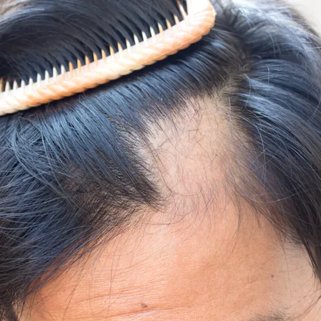 Părul tău merită mai mult: Dr. Diana Savu explică tot ce trebuie să știi despre alopecie și prevenție