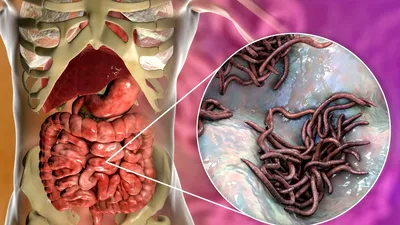 Cum îți dai seama că ai viermi intestinali. 20 de semne ale paraziților în organism